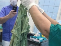 Орусияда дарыгерлер кесарево жолу менен төрөгөн айымдын ичине операция учурунда колдонуучу шейшепти тигип салып, ал бир айдан кийин алынды