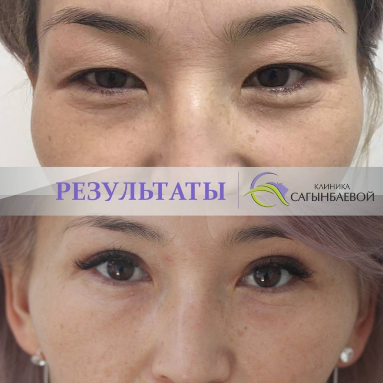 Көздүн сурмасын чыгаруу операциясынан кийинки жыйынтык.