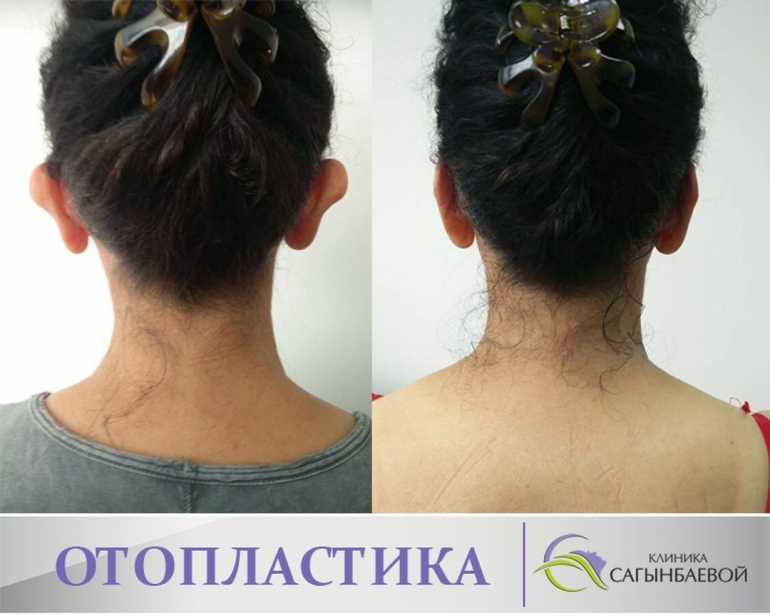 Кулактын формасын оңдоо же кичирейтүүгө жасалган операциянын жыйынтыгы.