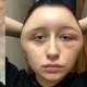 Парижде студент кыз аллергиялык тесттин жыйынтыгын күтпөй чачын боёп салып ооруканага түшүп калган