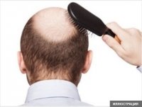 Индияда жигит таз болгону үчүн кудалашкан кызы ага турмушка чыгуудан баш тартты