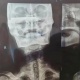 Кытайда 26 жыл башындагы 10 сантиметрлүү бычак менен жашаган адамга операция жасалды